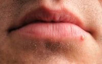 Penyebab kemunculan jerawat di bibir