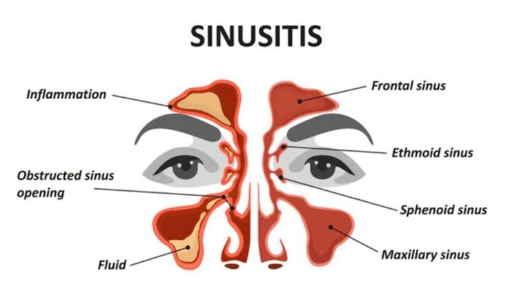 Mendadak sering pilek bisa menjadi salah satu gejala terkena sinusitis pada hidung jika tidak diperhatikan secara serius.