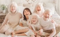 Kenali Tentang Anak Albino
