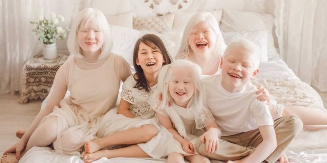 Kenali Tentang Anak Albino