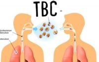 Mengenali Gejala TBC