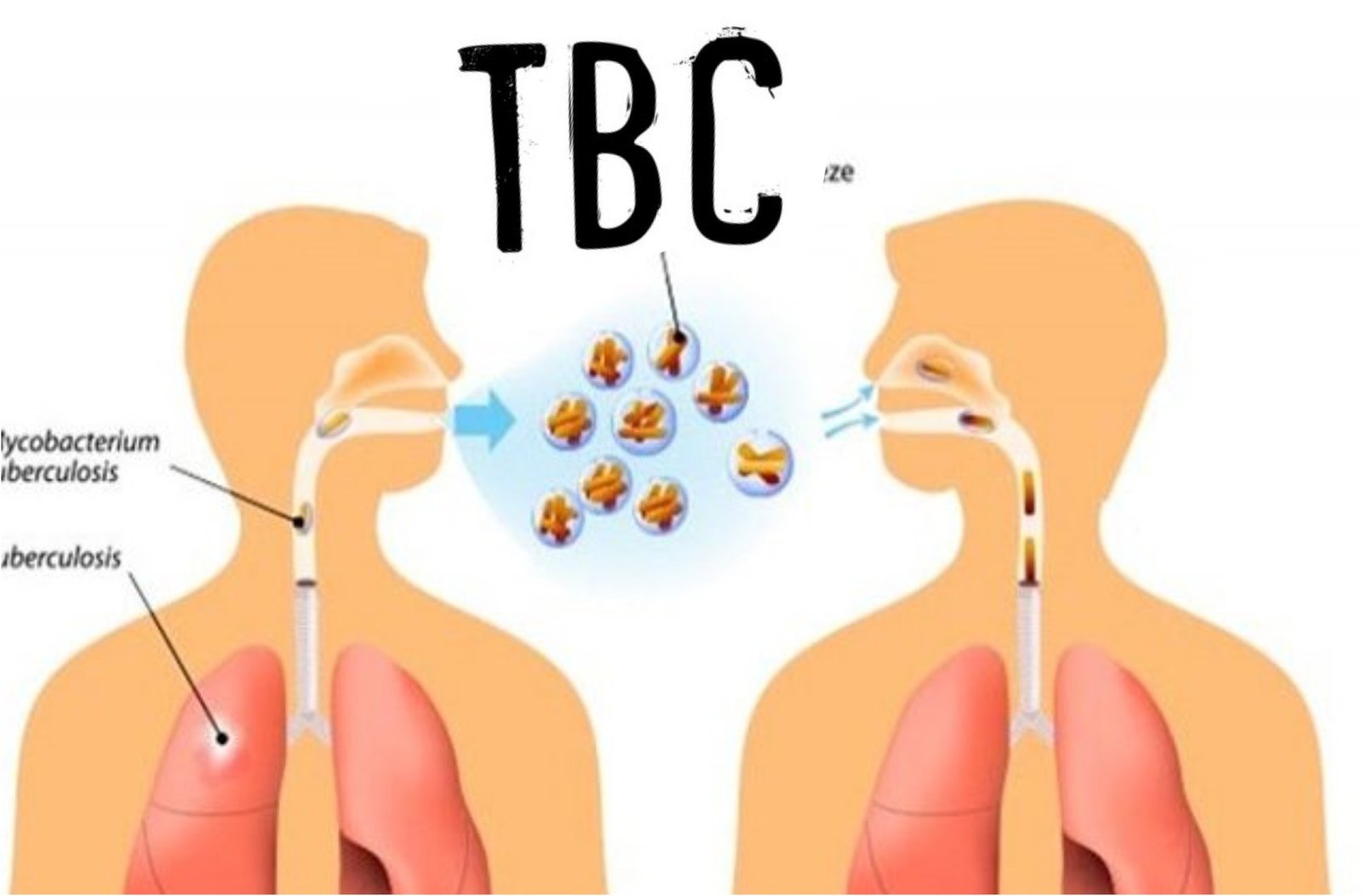 Penting Mengenali Gejala Tbc Sedari Dini Agar Bisa Mengantisipasi 